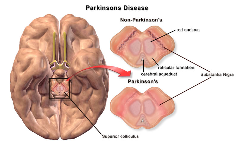 بحران انرژی در سلول های مغزی مسبب بیماری پارکینسون