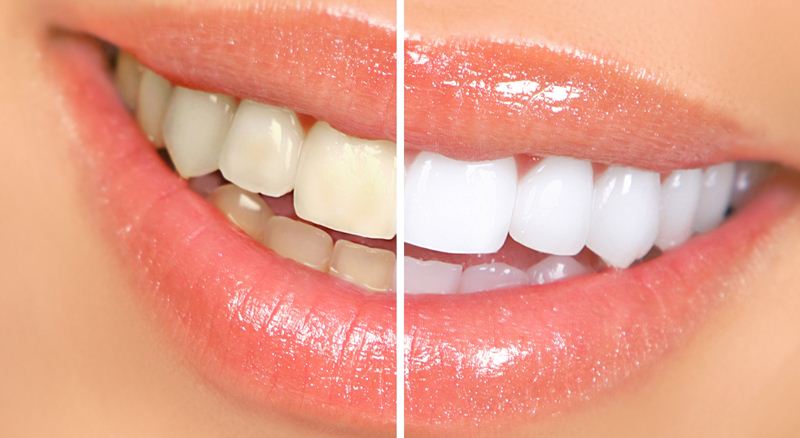 افزایش سفیدی دندان با برخی روش ها