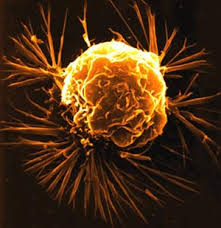 ارتباط بیماری هپاتیت C با سرطان کبد و دیگر سرطان ها
