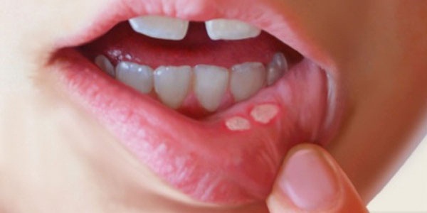 چگونه آفت دهان را درمان کنیم؟