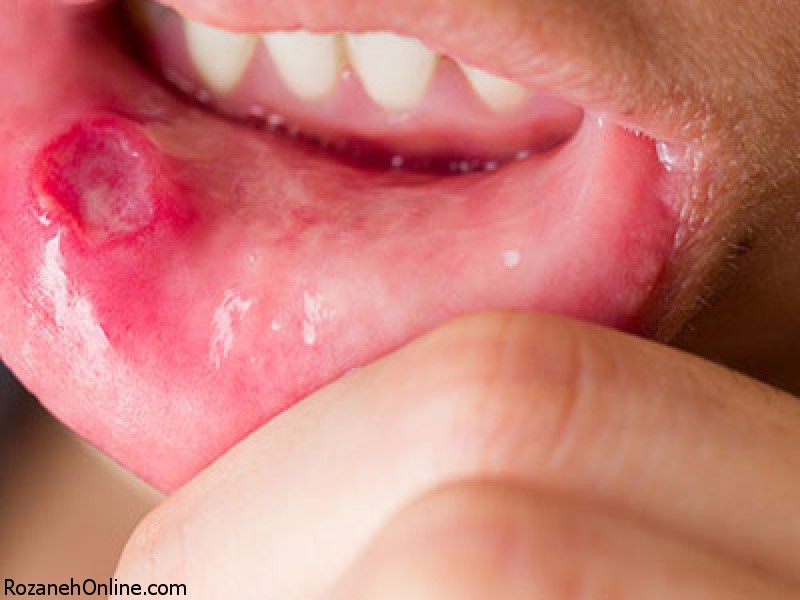 درمان آفت دهان بهمراه علائم و نشانه های آن