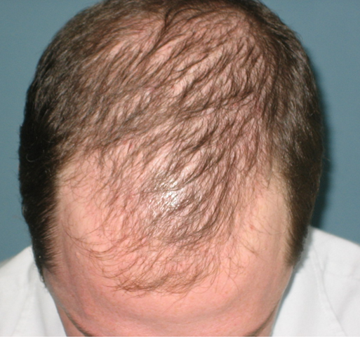 تاثیر شیمی درمانی بر ریزش مو