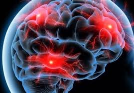 تحریک بیماری آلزایمر با ملتهب شدن مغز