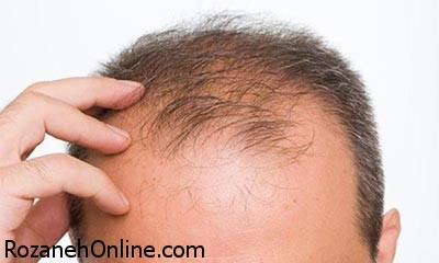 درمان کم پشتی مو و ریزش مو با قوی ترین مکمل ها