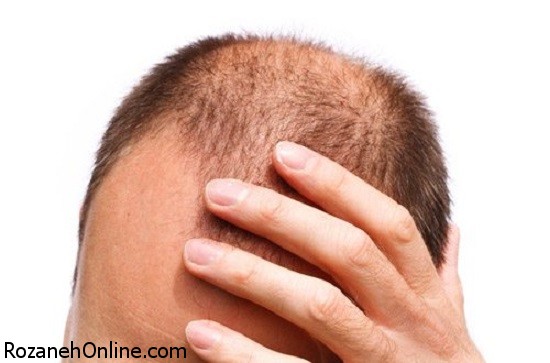 علت اصلی ریزش مو در زنان و مردان به چه عاملی بر میگردد؟