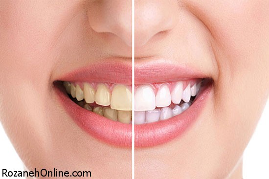 سفید کردن دندان ها بوسیله راههای کم هزینه خانگی