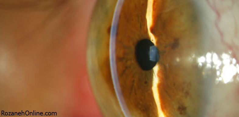 بیماری آب‌سیاه مشکلی جدی برای بینایی مردان 