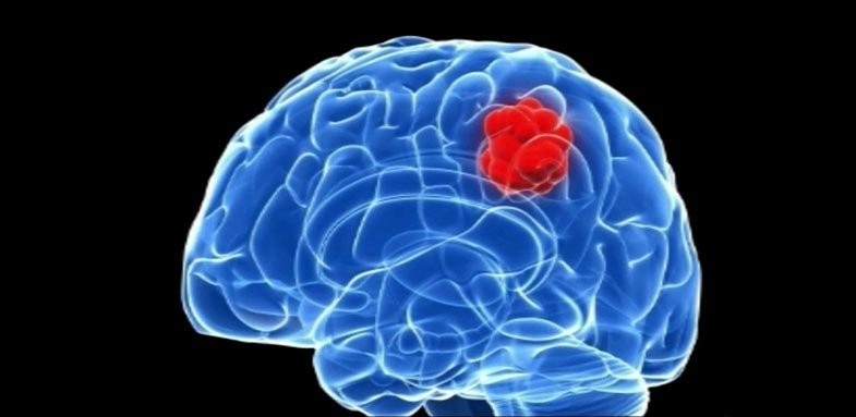 هشدارهای بدن ناشی از تومور مغزی