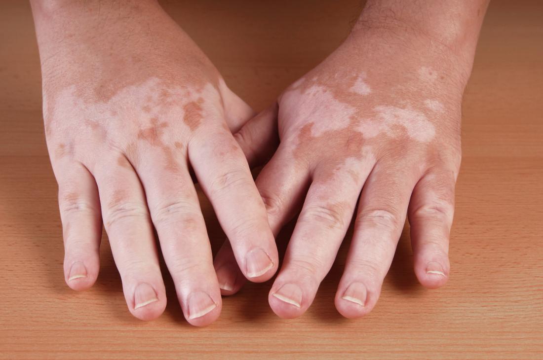 پیسی یا لکه های سفید روی پوست چیست و چه راه های درمانی برای آن وجود دارد؟