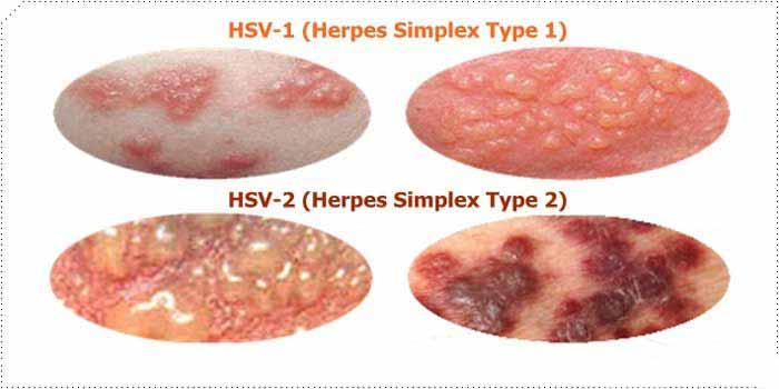 علت و درمان تب خال تناسلی زنان / ویروس هرپس