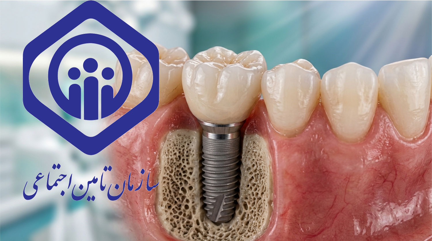 tamin-ejtemai-implant
